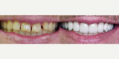 All-on-4 Dental Implants before and after photo