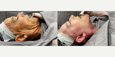 SMAS Facelift before and after photo