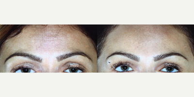 Botox before and after photo