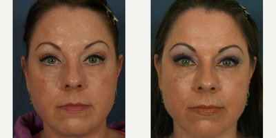 Cheek Augmentation before and after photo