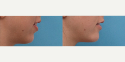 Chin Implant before and after photo