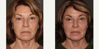 Eyelid Surgery before and after photo