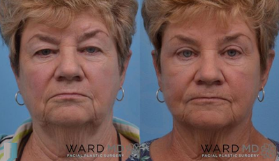 Eyelid Surgery before and after photo