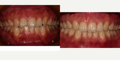 Invisalign before and after photo