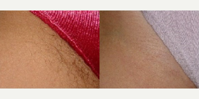 Laser Hair Removal before and after photo