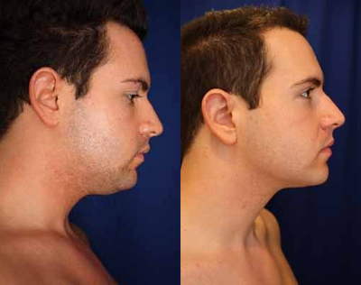 Liposuction before and after photo