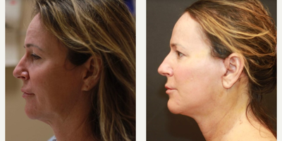 Neck Lift before and after photo