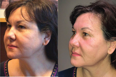 TempSure Envi before and after photo