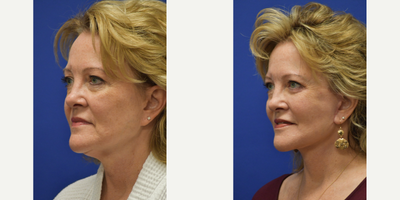 Facelift before and after photo