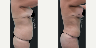 Mommy Makeover before and after photo