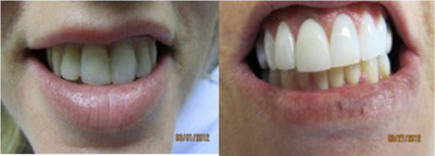 Porcelain Veneers before and after photo