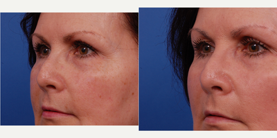 Voluma before and after photo