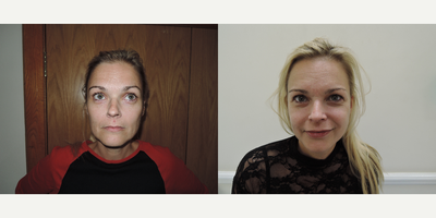 Facelift before and after photo