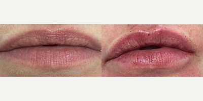 Lip Fillers before and after photo