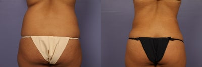 Liposuction before and after photo