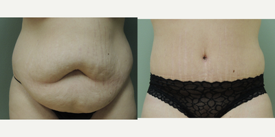 Tummy Tuck before and after photo