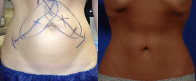 CoolSculpting before and after photo