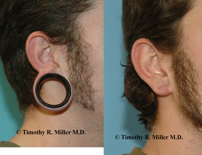 Earlobe Repair before and after photo
