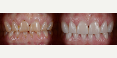 Porcelain Veneers before and after photo