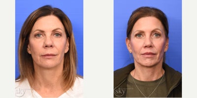 Rhinoplasty before and after photo