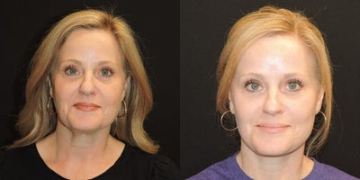 Deep Plane Facelift before and after photo