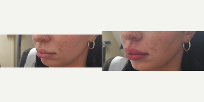 Dermal Fillers before and after photo