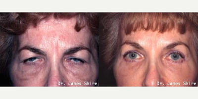Eyelid Surgery before and after photo