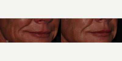 Lip Fillers before and after photo