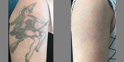 Tattoo Removal before and after photo