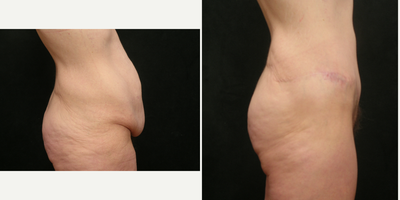 Body Lift before and after photo