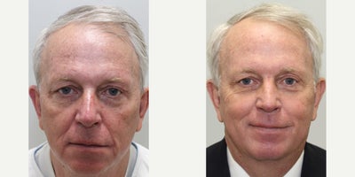 CO2 Laser before and after photo
