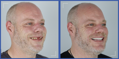 Dental Implants before and after photo