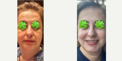 before and after image