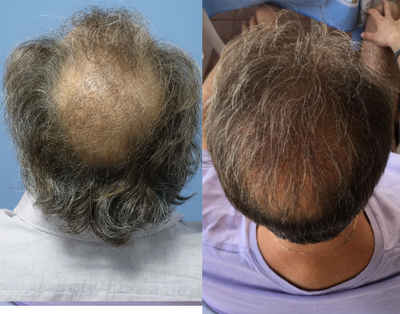 FUE Hair Transplant before and after photo