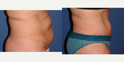 Liposculpture before and after photo