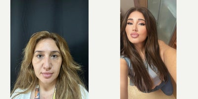 Mini Facelift before and after photo
