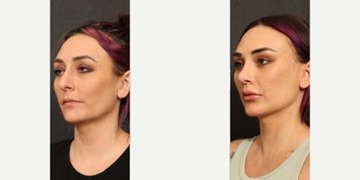 Neck Lift before and after photo