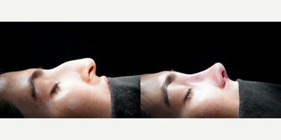 Rhinoplasty before and after photo