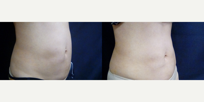SculpSure before and after photo