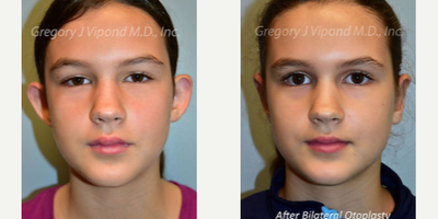 Ear Surgery before and after photo