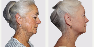 Facelift before and after photo