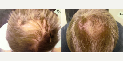 Hair Loss Treatment before and after photo