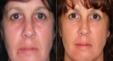 Nonsurgical Facelift before and after photo