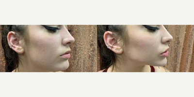 Radiesse before and after photo