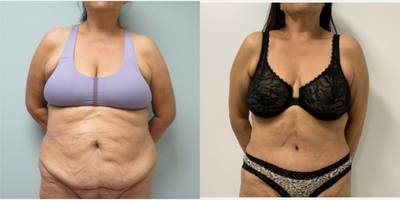 Tummy Tuck before and after photo