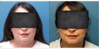 Chin Liposuction before and after photo
