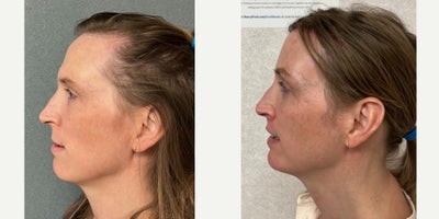 Genioplasty before and after photo