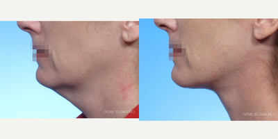 Neck Lift before and after photo