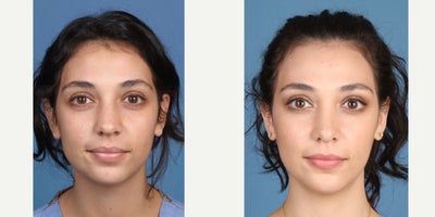 Rhinoplasty before and after photo