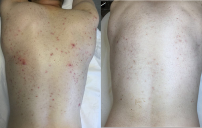 Chemical Peel before and after photo